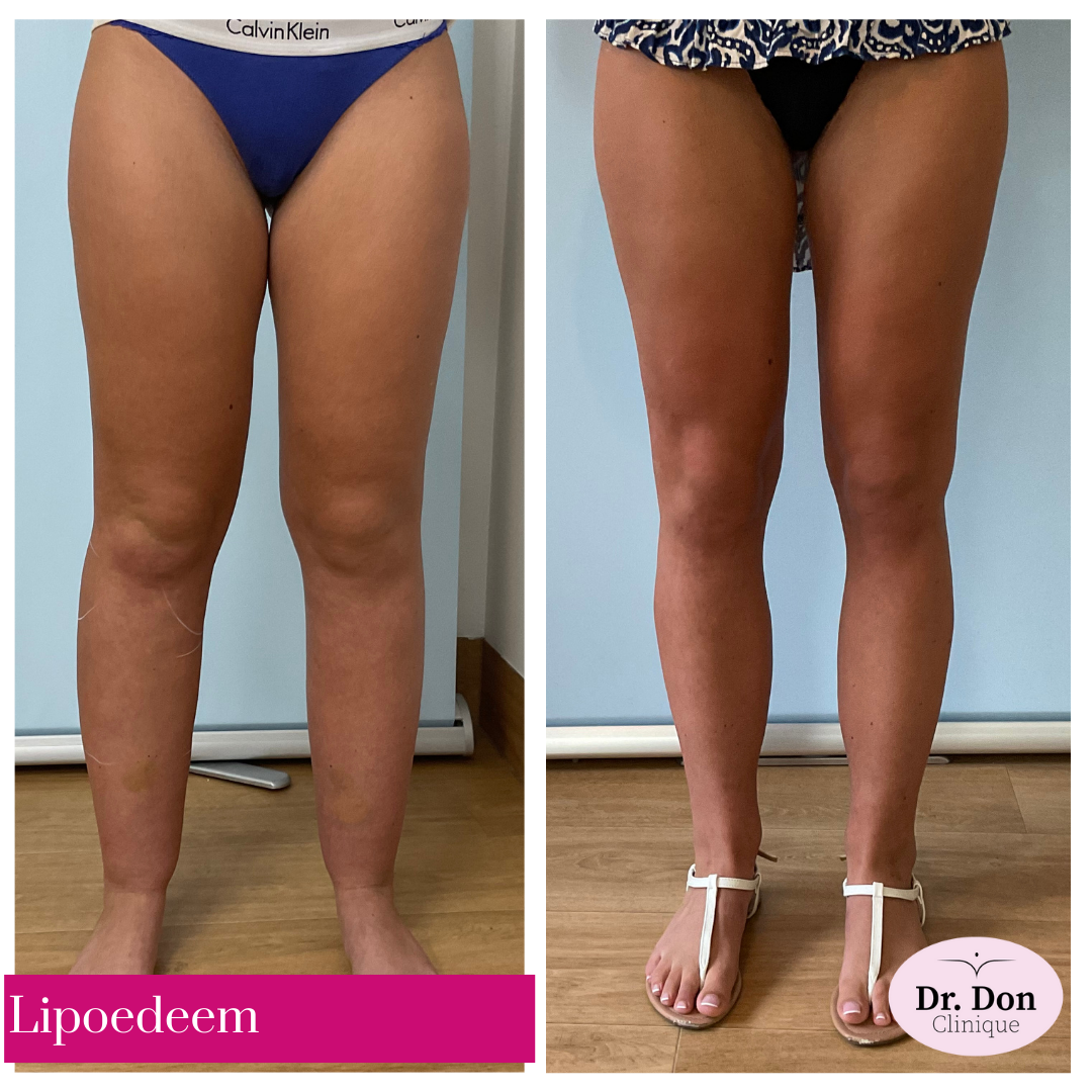 lipoedeem bene clinique dr. don